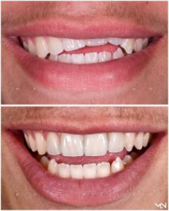 Teeth Whitening