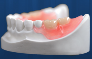 Partial Denture Image